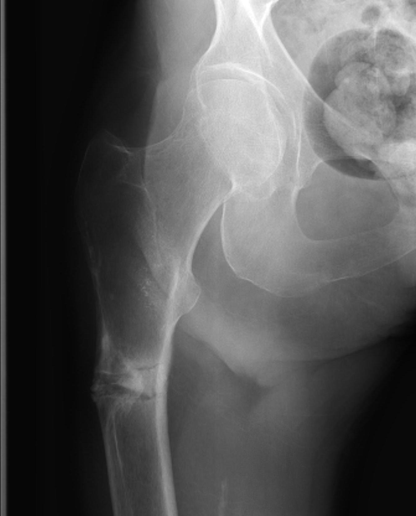 Bisphosphonates Femoral insufficiency fracture